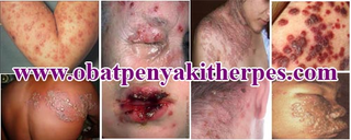 Illustration for article titled Pengobatan Penyakit Herpes